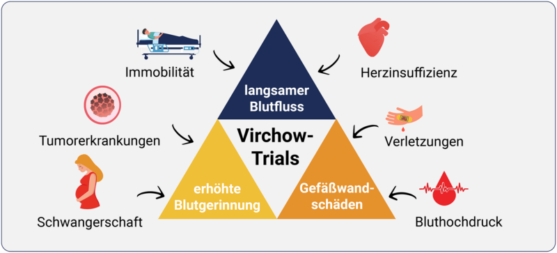 Visuelle Darstellung: Die Virchow-Trias und ihre Rolle in der Thrombose